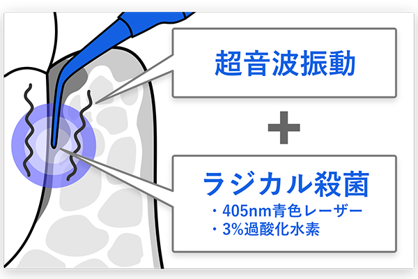 超音波振動とラジカル殺菌